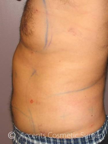 Body Jet Smartlipo Before and After 03