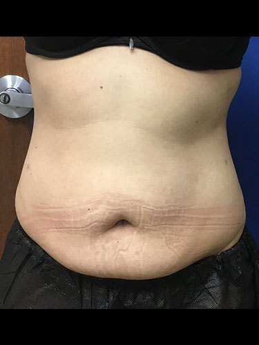 Body Jet Smartlipo Before and After 04