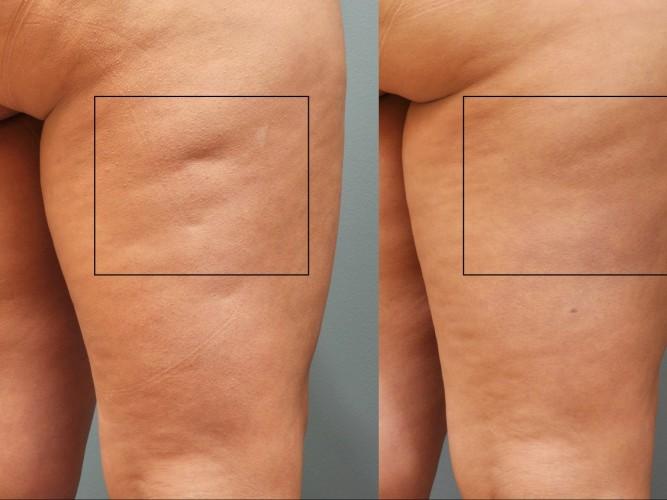 Cellulaze Before and After 02