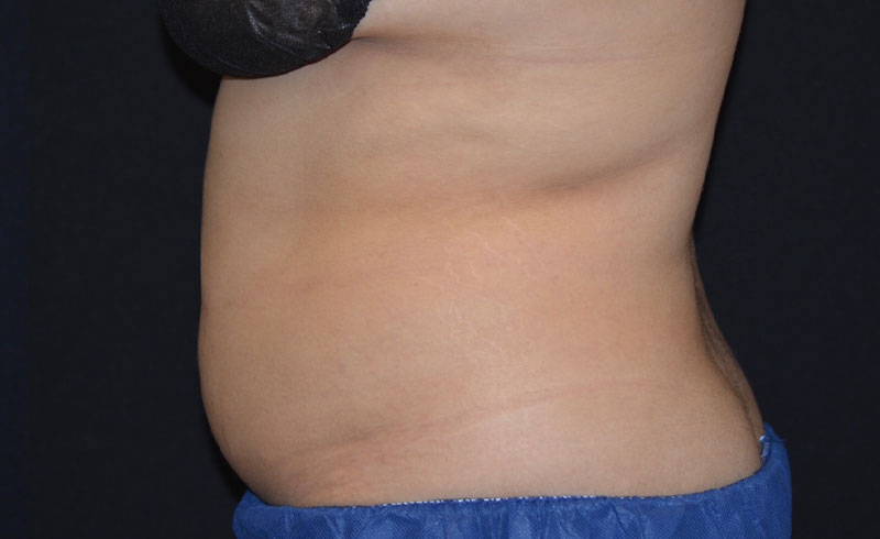 Coolsculpting Female Abs Before and After 06