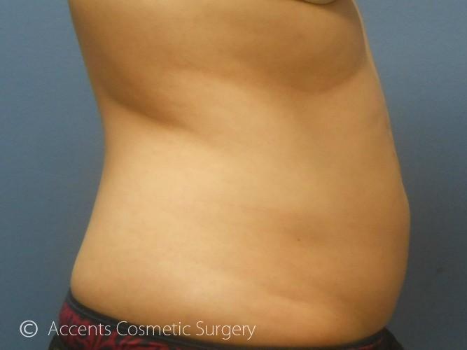 Coolsculpting Female Abs Before and After 04