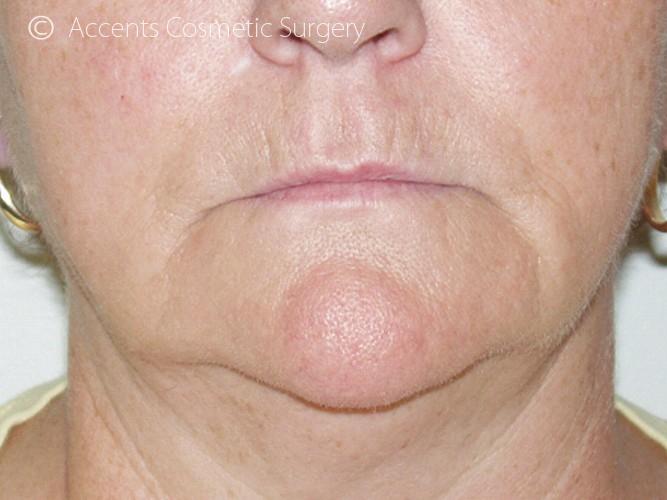 Thermage Face And Neck Before and After 01