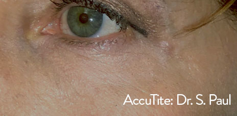 Accutite Before and After 01