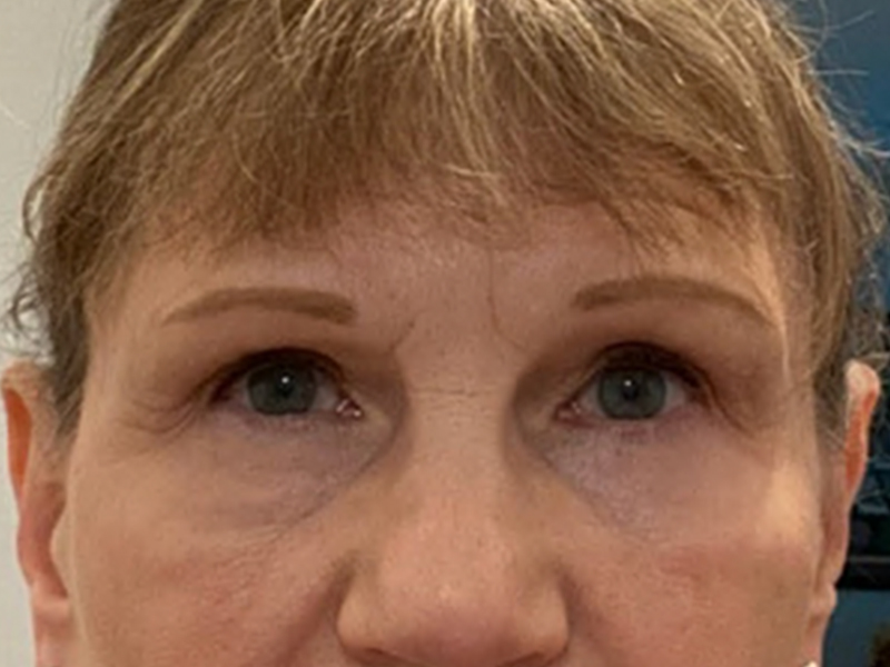 Blepharoplasty Before and After 07