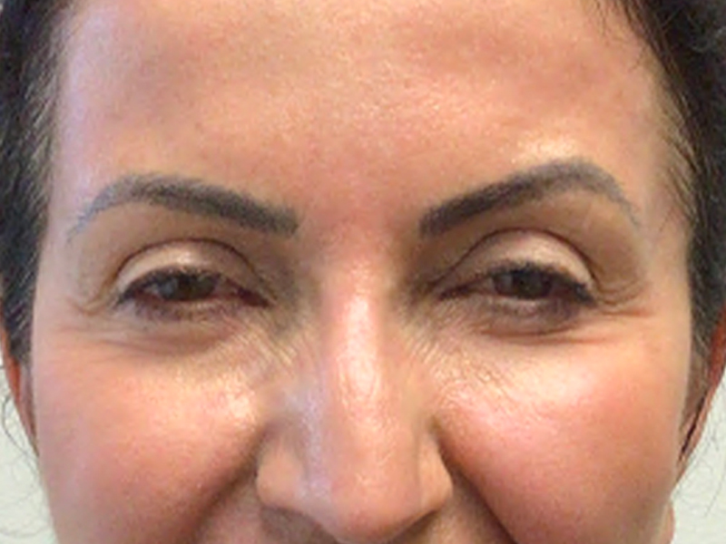 Blepharoplasty Before and After 01