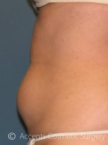 Body Jet Smartlipo Before and After 01