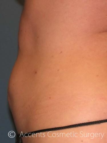 Body Jet Smartlipo Before and After 02