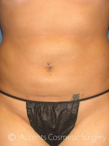 Body Jet Smartlipo Before and After 07