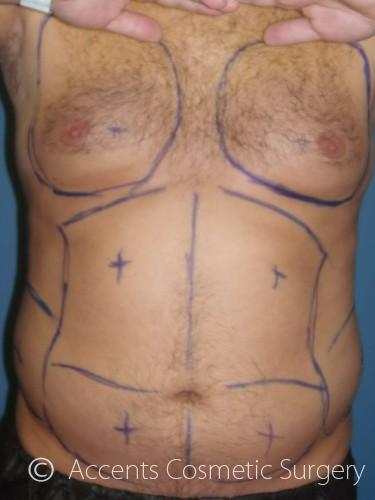 Body Jet Smartlipo Before and After 03