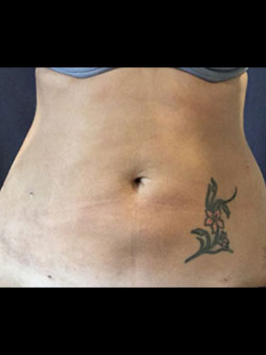 Body Jet Smartlipo Before and After 09