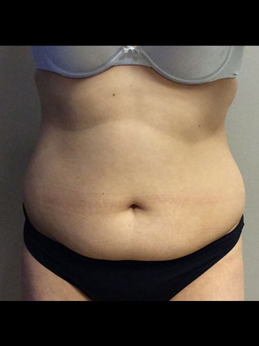 Body Jet Smartlipo Before and After 05