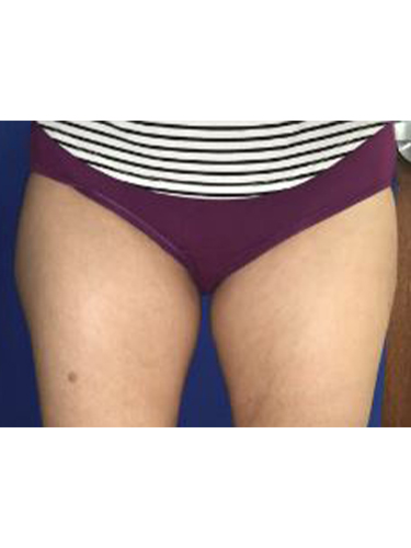 Body Jet Smartlipo Before and After 09