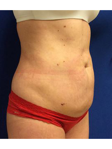 Body Jet Smartlipo Before and After 02