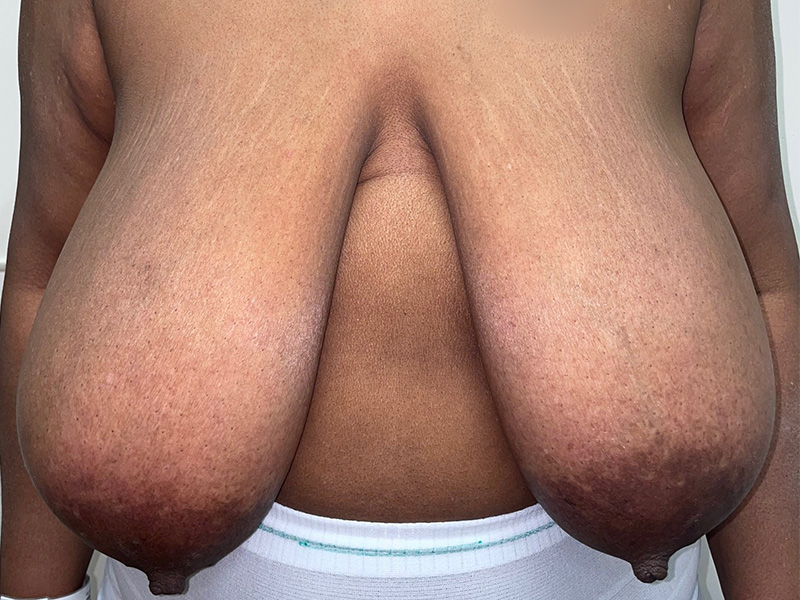 Breast Reduction With Lift Before and After 05