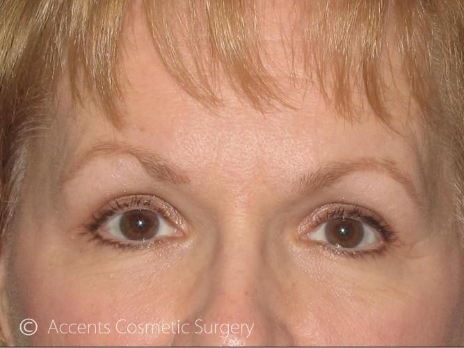Brow Lift Before and After 04