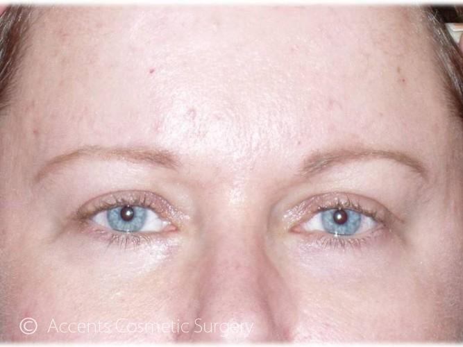 Brow Lift Before and After 02