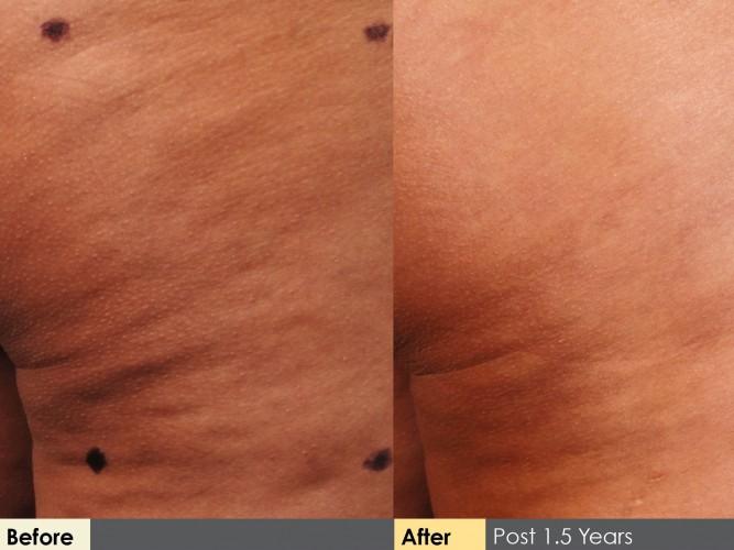 Cellulaze Before and After 01