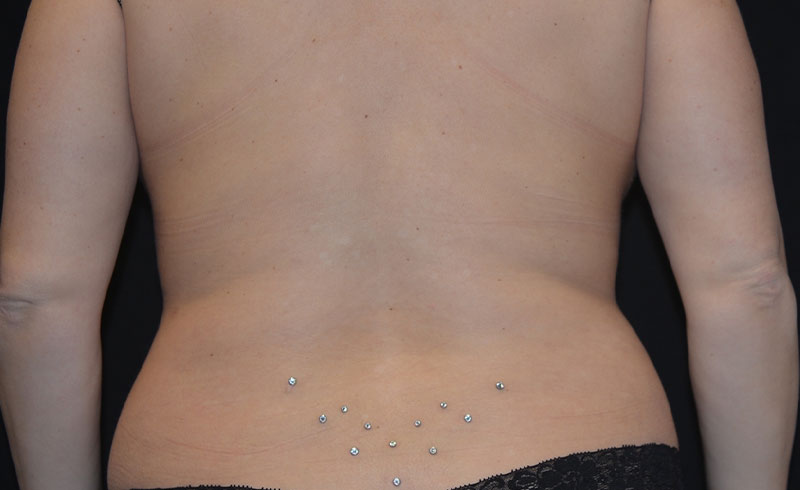 Coolsculpting Bra Line Before and After 02
