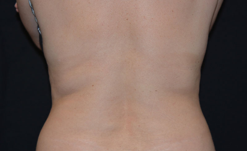 Coolsculpting Bra Line Before and After 01
