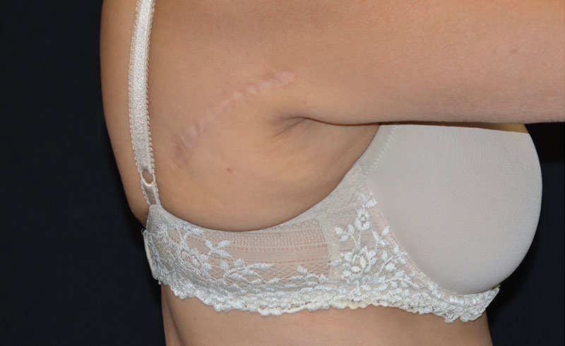 Coolsculpting Bra Line Before and After 01