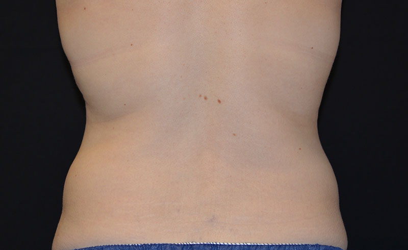 Coolsculpting Bra Line Before and After 03