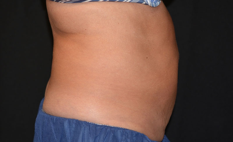 Coolsculpting Female Abs Before and After 05