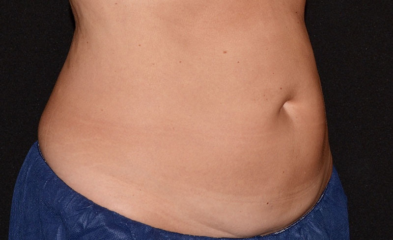 Coolsculpting Female Abs Before and After 08