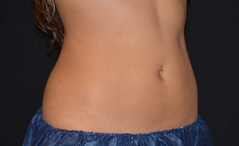 Coolsculpting Female Abs Before and After 03