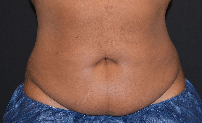 Coolsculpting Female Abs Before and After 25