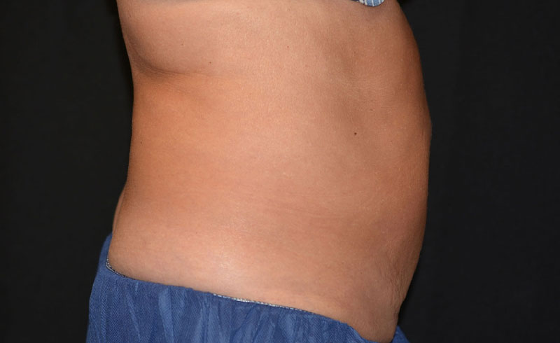 Coolsculpting Female Abs Before and After 26