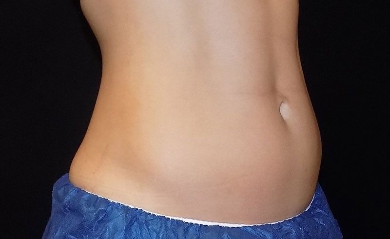 Coolsculpting Female Abs Before and After 08