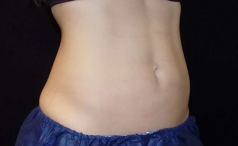 Coolsculpting Female Abs Before and After 19
