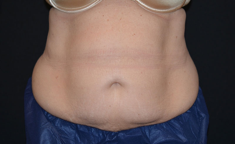 Coolsculpting Female Abs Before and After 25