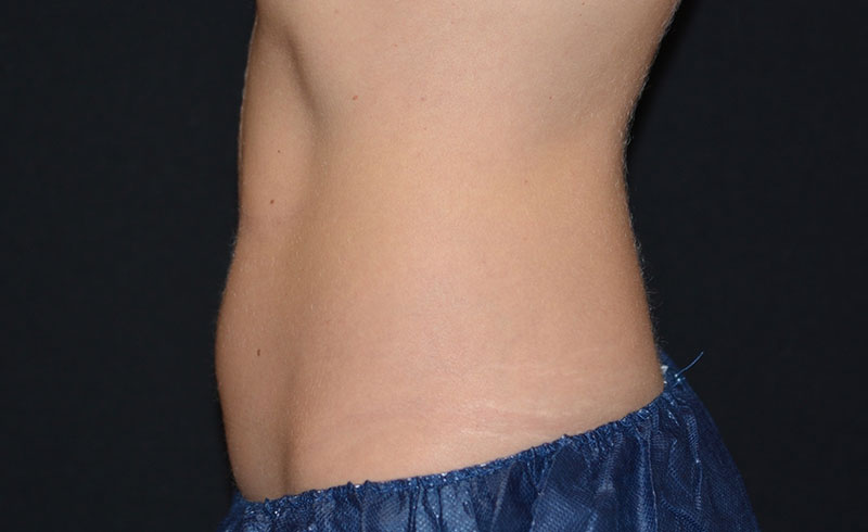 Coolsculpting Female Abs Before and After 26