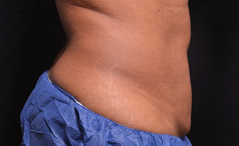 Coolsculpting Female Abs Before and After 01