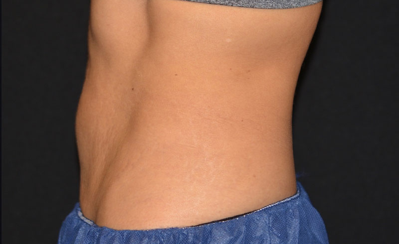 Coolsculpting Female Abs Before and After 06