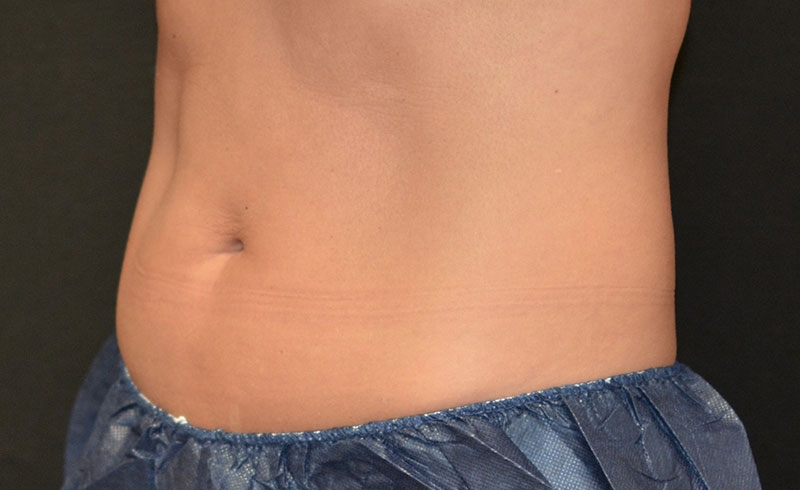 Coolsculpting Female Abs Before and After 03