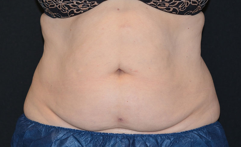 Coolsculpting Female Abs Before and After 12