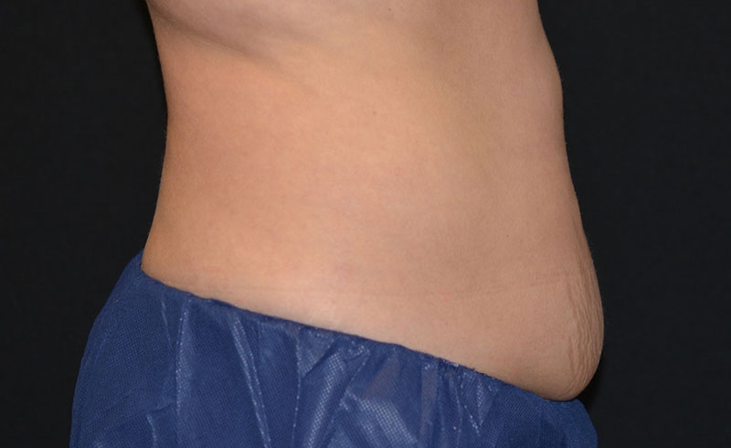 Coolsculpting Female Abs Before and After 04