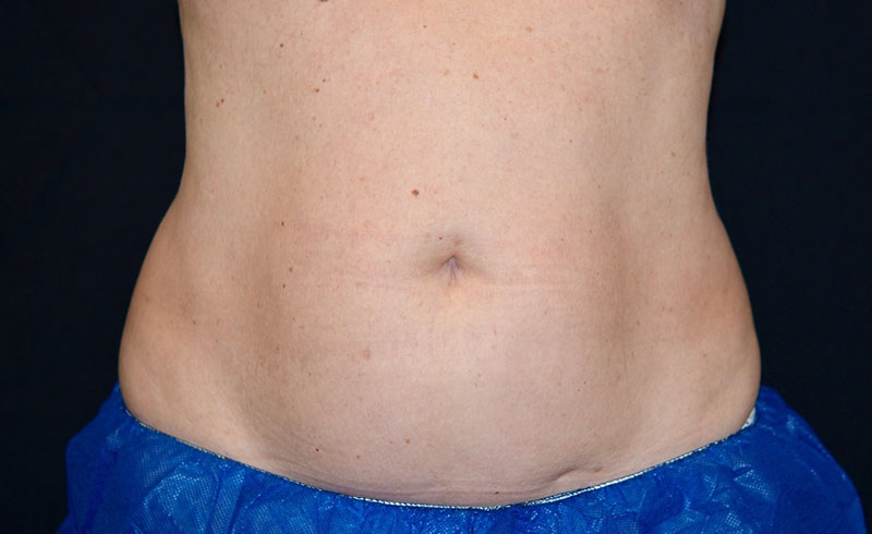 Coolsculpting Female Abs Before and After 07