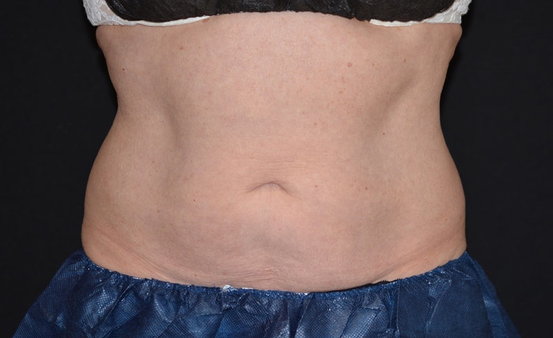 Coolsculpting Female Abs Before and After 15