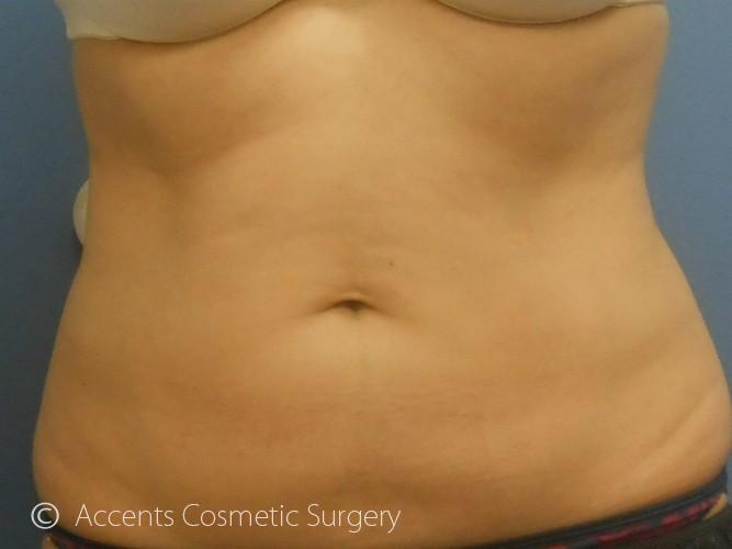 Coolsculpting Female Abs Before and After 22