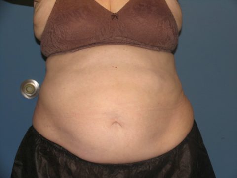 Coolsculpting Female Abs Before and After 24
