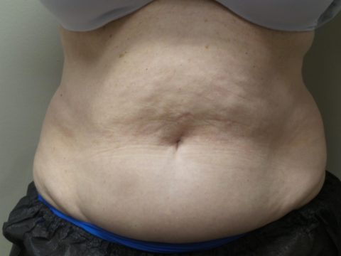 Coolsculpting Female Abs Before and After 09