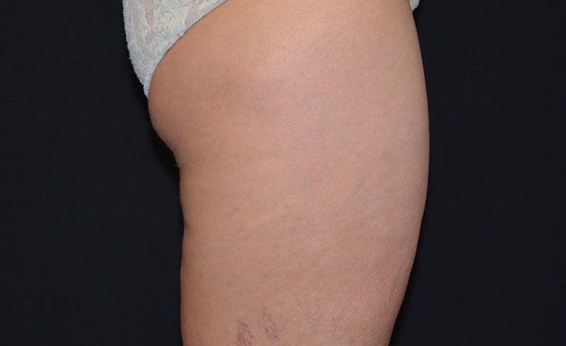 Coolsculpting Female Banana Roll Before and After 01