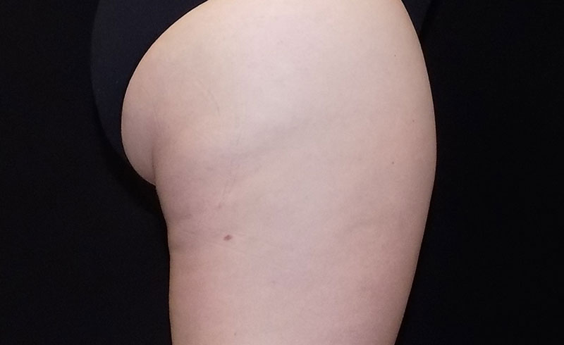 Coolsculpting Female Banana Roll Before and After 03