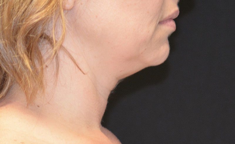 Coolsculpting Female Double Chin Before and After 01
