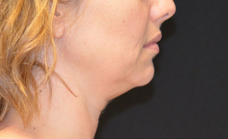 Coolsculpting Female Double Chin Before and After 02