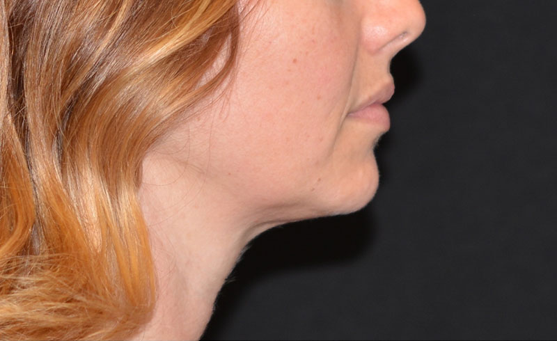 Coolsculpting Female Double Chin Before and After 06