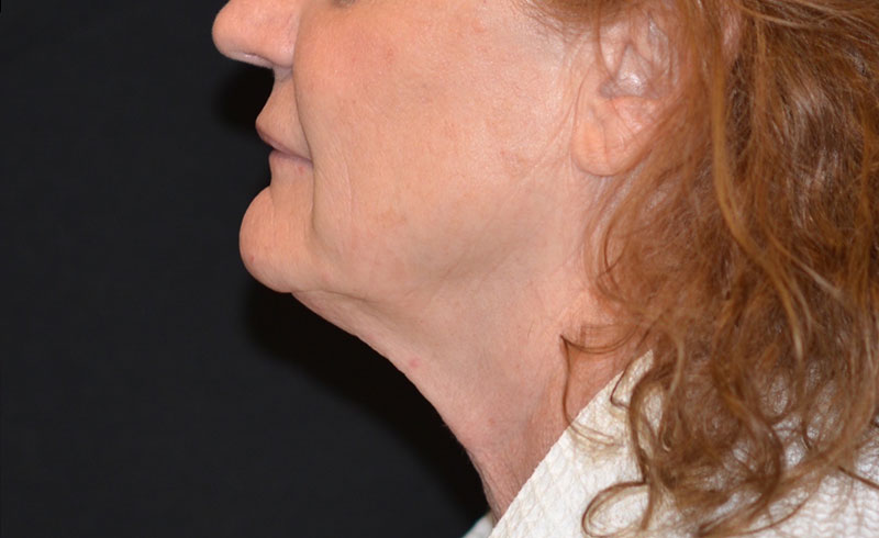 Coolsculpting Female Double Chin Before and After 04